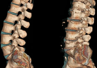 Osteochondrose