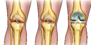 was ist Arthrose