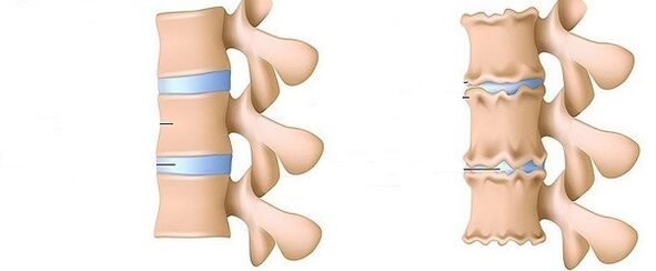 eine gesunde Wirbelsäule und Osteochondrose
