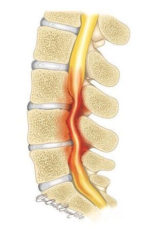 Bei Osteochondrose der Brustwirbelsäule kommt es zu einer Kompression des Wirbelkanals