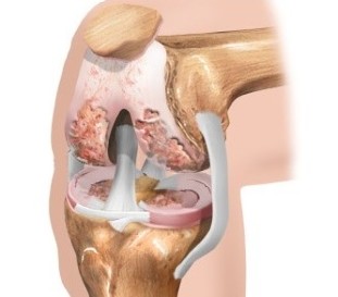 Der Knorpel im Knie