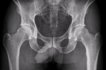 Diagnoseoptionen für die Arthrose des Hüftgelenks