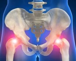 Die Ursachen für Arthrose des Hüftgelenks