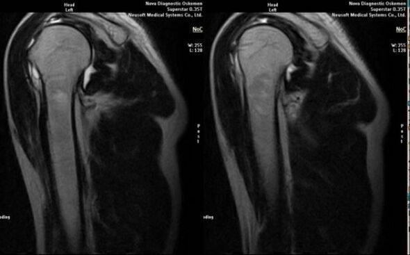 Röntgen zur Diagnose einer Schulterarthrose