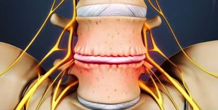 Wirbelsäulenläsionen aufgrund von Osteochondrose