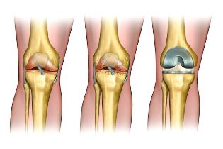 der Grad der Arthrose