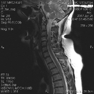 Osteochondrose und Spondylose der Halswirbelsäule